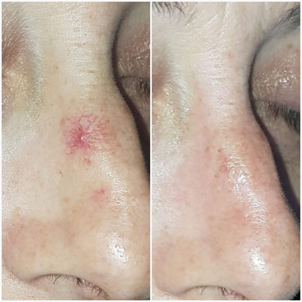 Spider veins and thread veins (telangiectasia) Kumiega